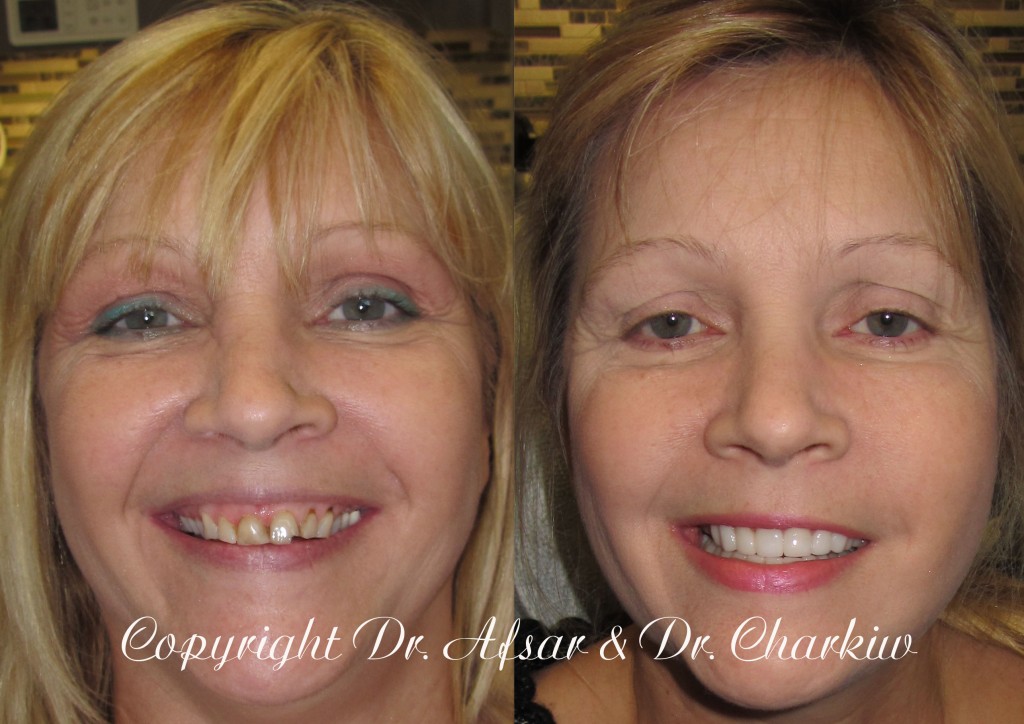 crookedgummystained5