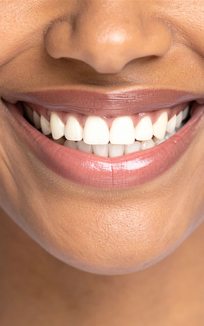 woman smile veneers